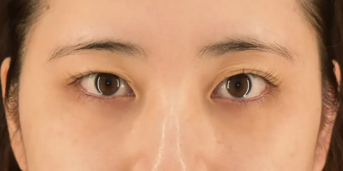 眼瞼下垂施術例１：術前