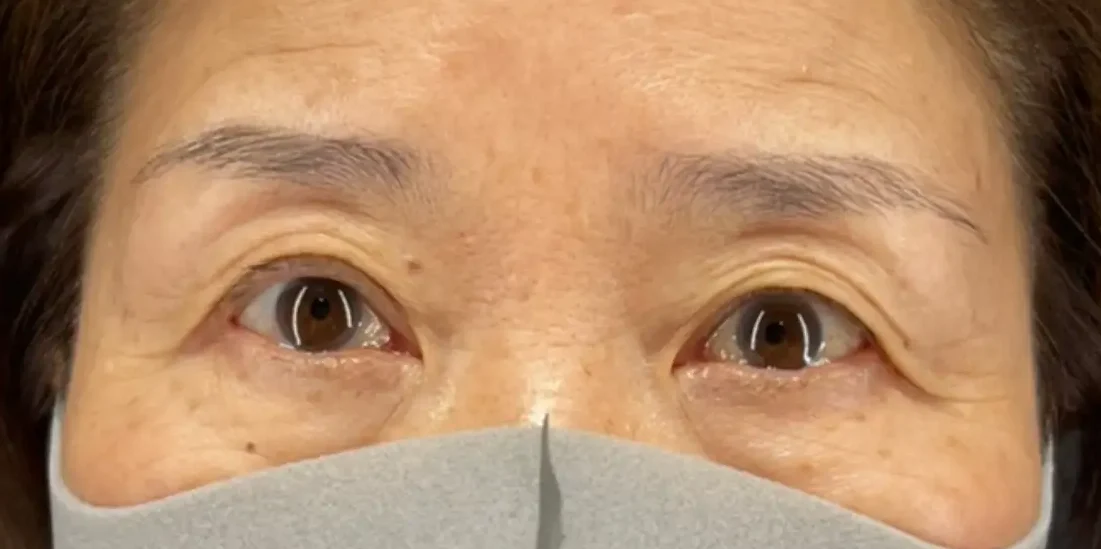 眼瞼下垂施術例２：術後