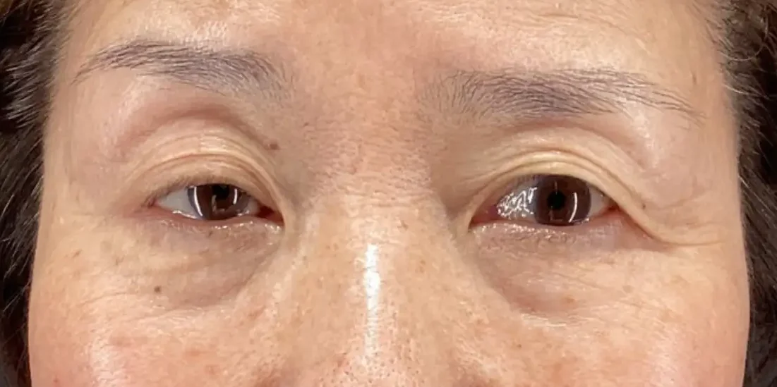眼瞼下垂施術例２：術前