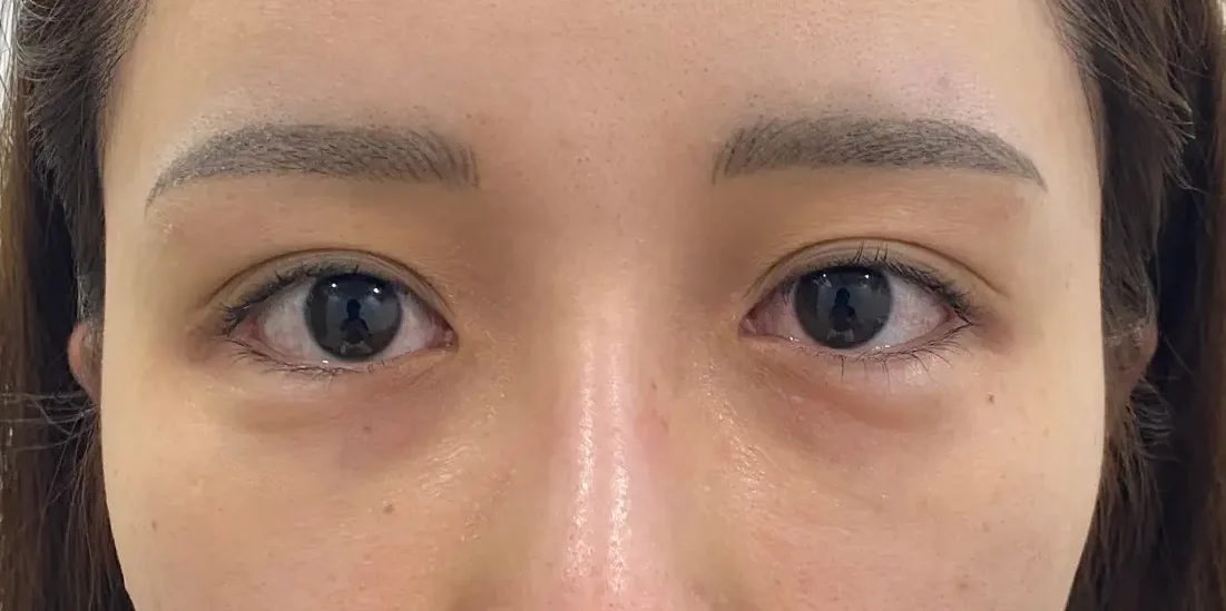 眼瞼下垂施術例３：術前