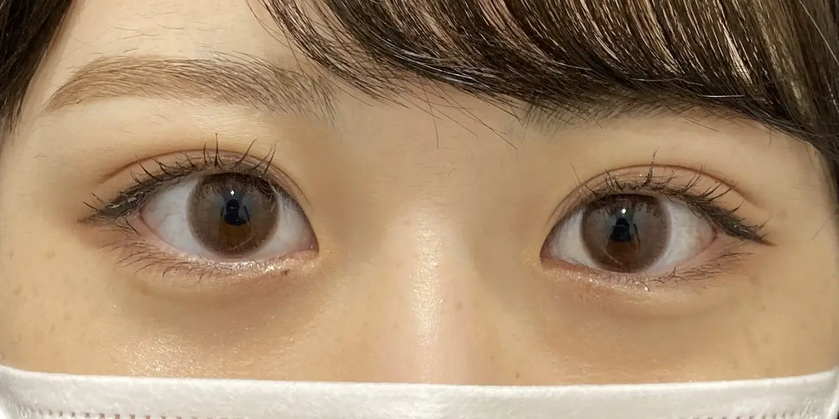 瞼の脂肪を落とすには: まぶたの脂肪をとる方法 _ 腫れぼったいまぶたは脂肪除去で治る? – NTWD