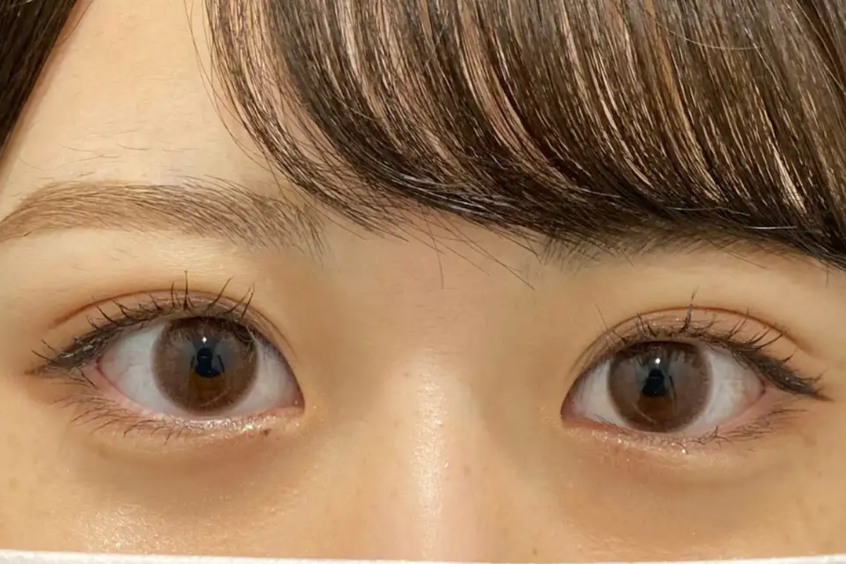 瞼の脂肪取りの施術内容と値段🌿HAABクリニック【公式】