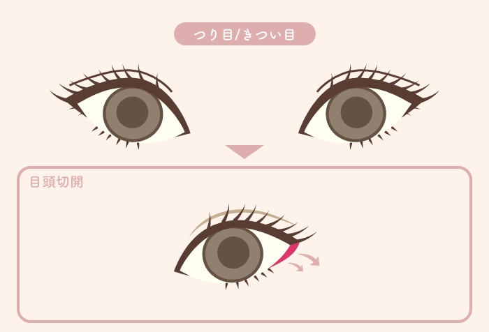 目の二重整形のつり目/きつい目でお悩みの方におすすめの施術