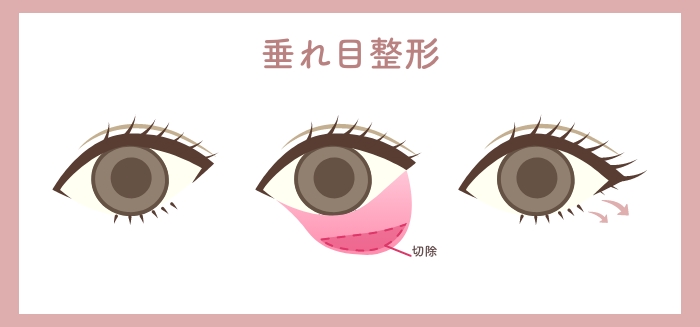 目の二重整形のHAABクリニックの目元整形の特徴垂れ目整形