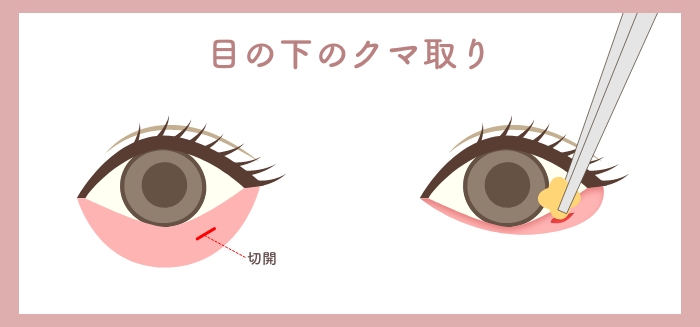 目の二重整形のHAABクリニックの目元整形の特徴目の下のクマ治療