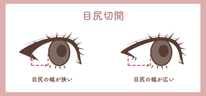 目の二重整形のHAABクリニックの目元整形の特徴目尻切開