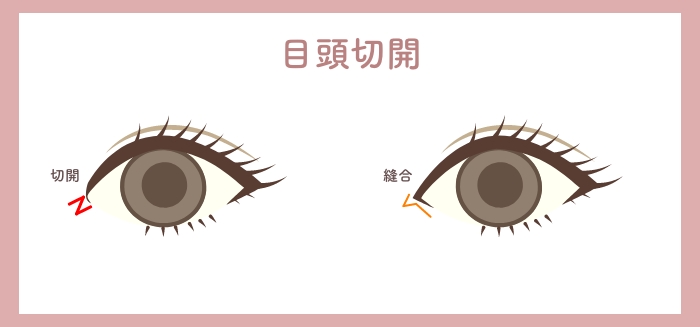 目の二重整形のHAABクリニックの目元整形の特徴目頭切開