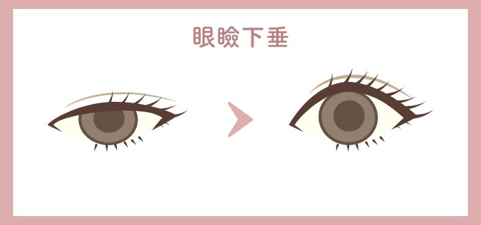 目の二重整形のHAABクリニックの目元整形の特徴眼瞼下垂手術