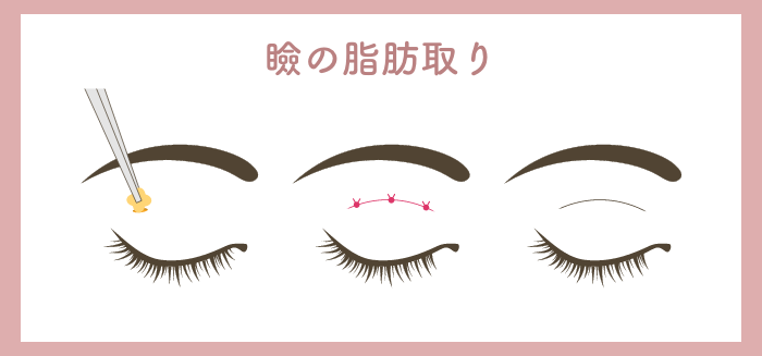 瞼の脂肪取りの施術内容と値段🌿HAABクリニック【公式】