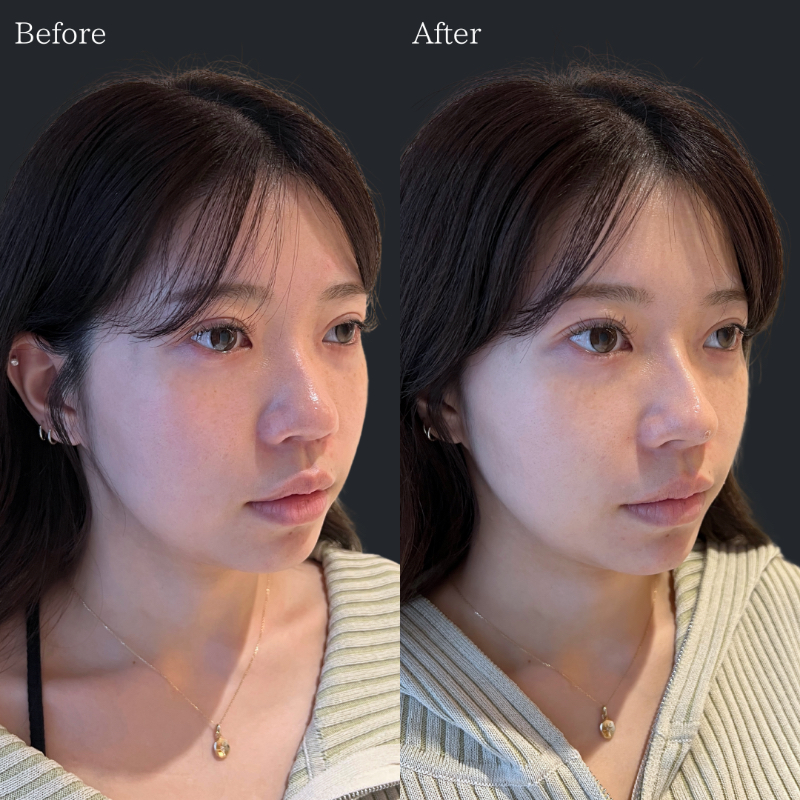 30代 HA鼻先,貴族,唇,口下,顎