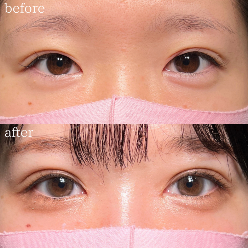 20代 ドリームダブル、目頭切開