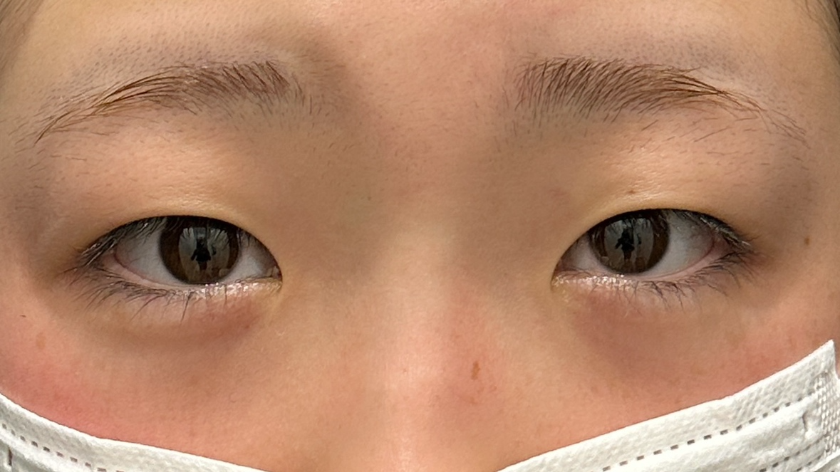 HAABクリニック 二重前没ドリームダブル・まぶたの脂肪取り 術前