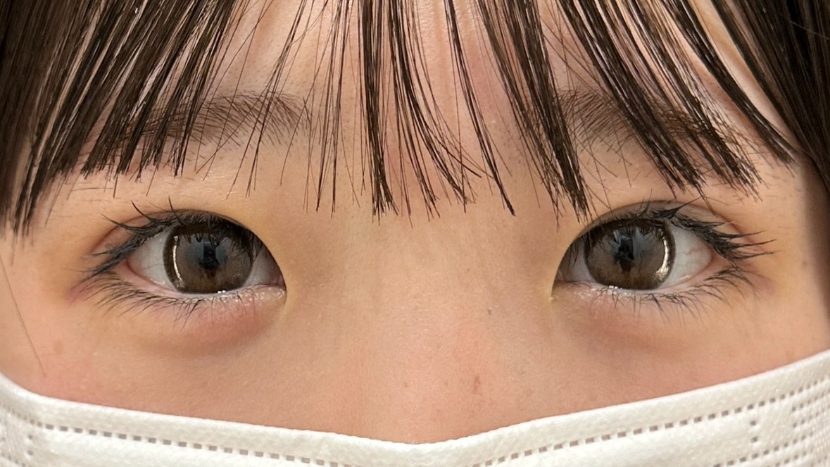 HAABクリニック 二重前没ドリームダブル・まぶたの脂肪取り 術後