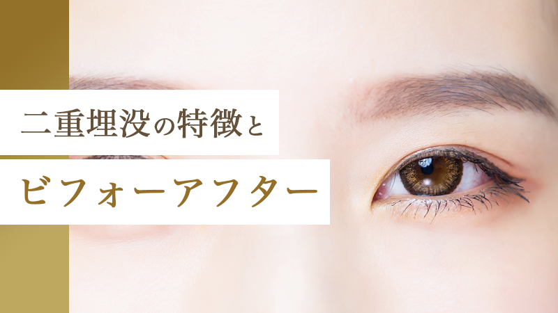 二重埋没の特徴とビフォーアフター｜HAABクリニック
