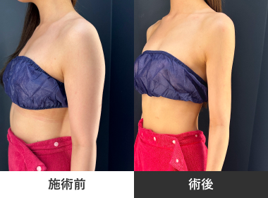 二の腕脂肪吸引
