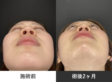 小鼻縮小・鼻尖形成