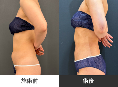 腹部脂肪吸引
