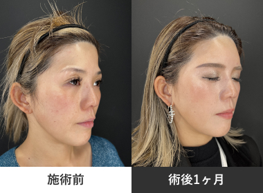 額の脂肪注入