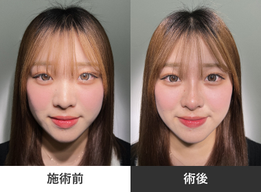 鼻ヒアルロン酸