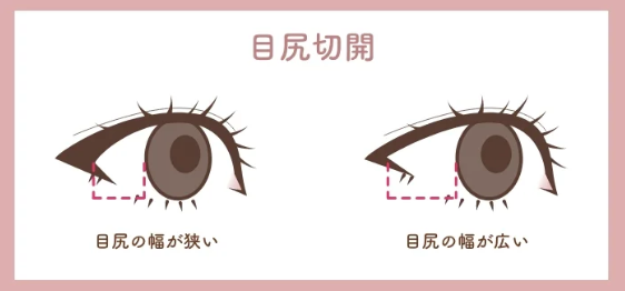 目尻切開とは｜HAABクリニック