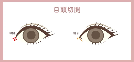 目頭切開