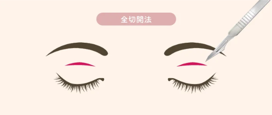 二重切開の種類｜全切開法｜HAABクリニック