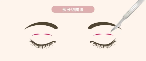 二重切開の種類｜部分切開法｜HAABクリニック