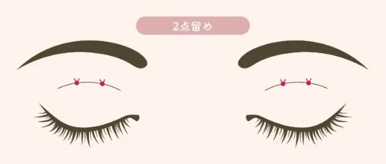 二重埋没の種類｜2点留め｜HAABクリニック