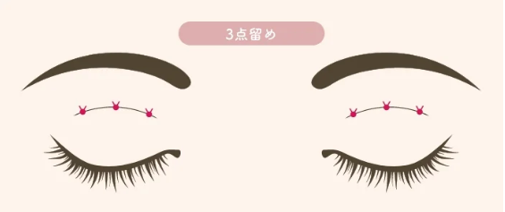 二重埋没の種類｜3点留め｜HAABクリニック