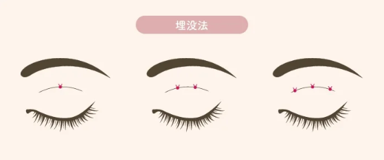 二重埋没の種類｜2点留めと3点留め｜HAABクリニック